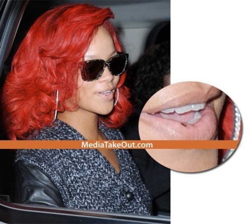 Does Rihanna Have Herpes
